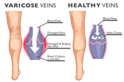 Varicose Veins Disease Doctors at Maryland USA